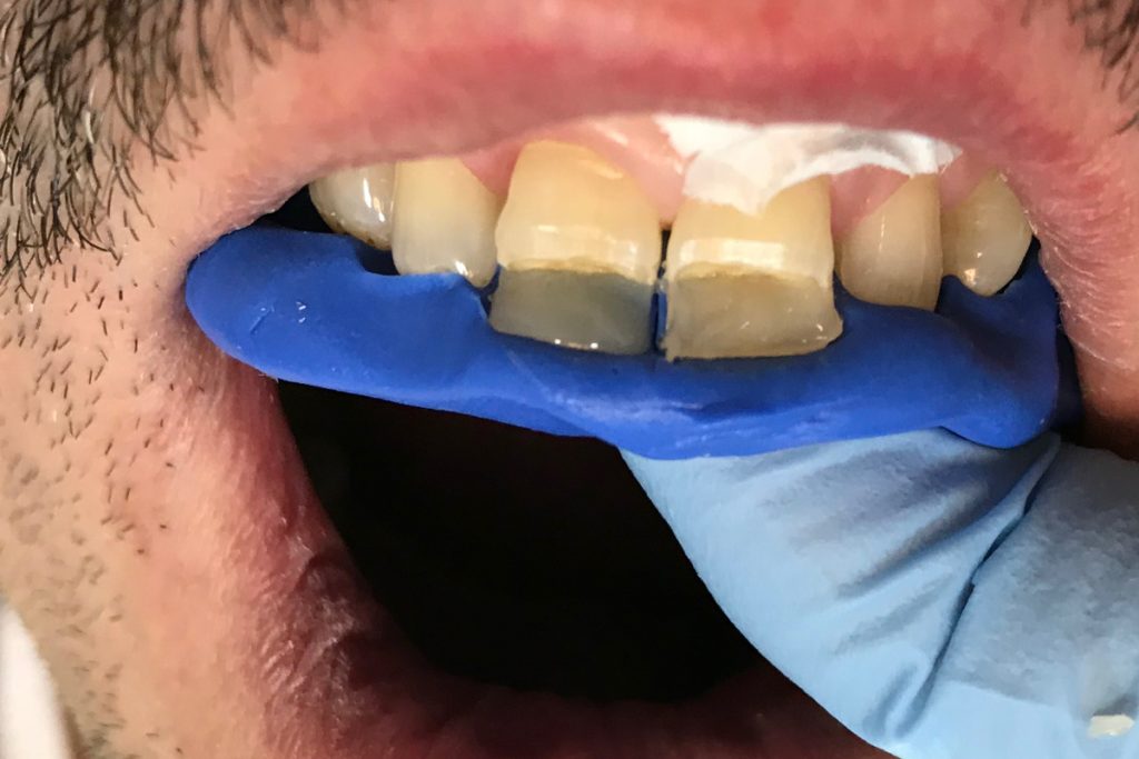indeks sylikonowy do odbudowy zęba